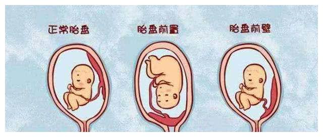 怀孕,胎盘位于前壁,可以经常散步吗?散步时间大概多久合适?|胎盘|怀孕|后壁_新浪新闻