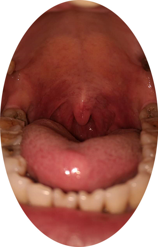 由于儿童长期感冒会导致慢性咽炎的形成,所以您看它的后咽壁的时候会