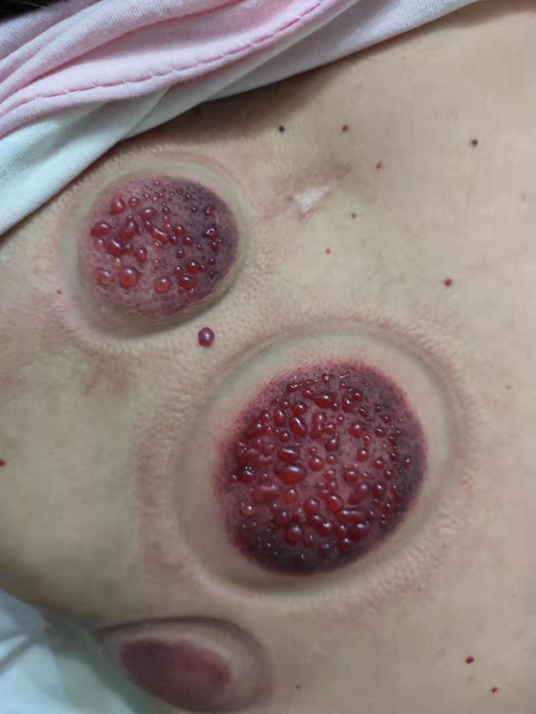 治疗疾病医患信任是治病的基础|水泡|拔火罐|医患_新浪网