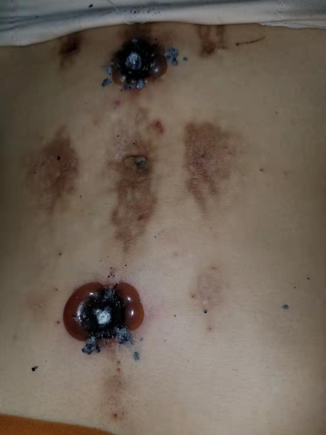 艾灸的排病反应