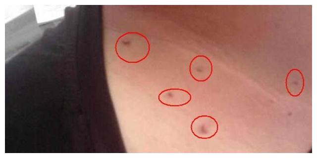 怎样鉴别宝宝淋巴结有没有炎症?