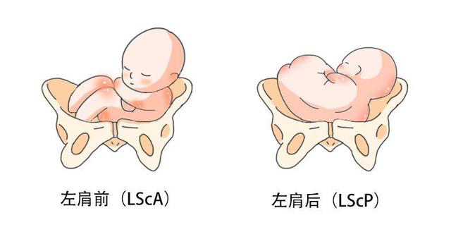对胎位的描述LOA \ ROA \ LSA是????