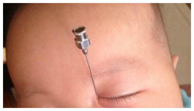 宝宝不哭也流泪,医生用针插入宝宝泪管,流出的液体妈妈蒙