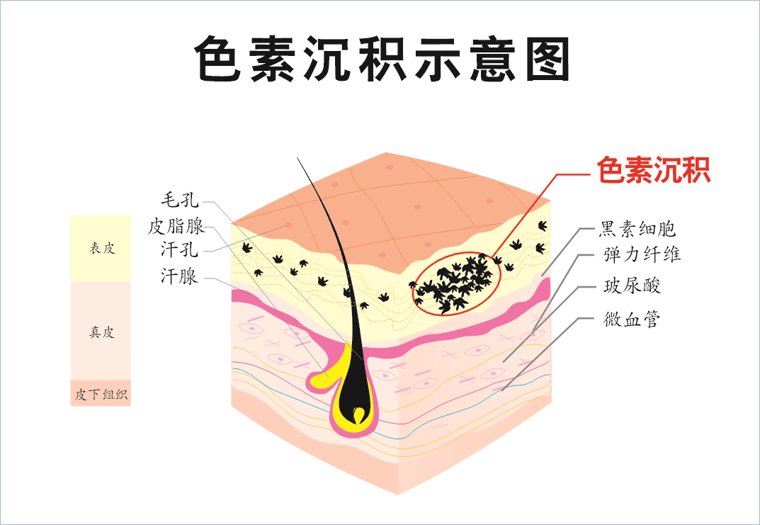 长黄褐斑秒变黄脸婆每天5分钟中医皮肤教你排色素淡色斑