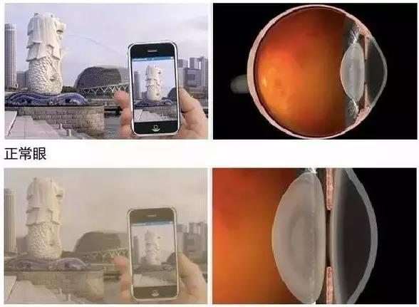 还在滴眼药水治疗白内障吗?