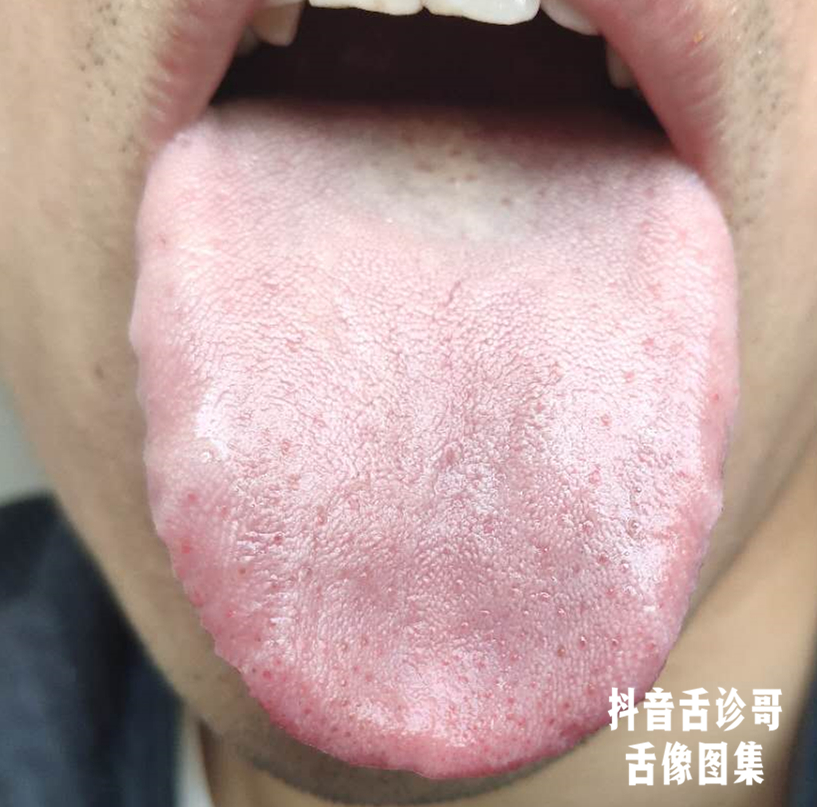 舌诊哥舌诊知健康教你学会看舌象系列五十一