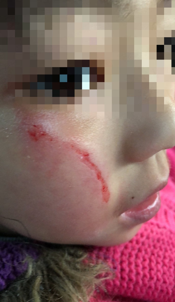 可以清晰的看到,稚嫩的脸上确实有一条明显的伤疤,看后令人揪心!