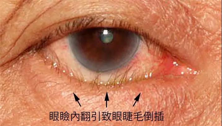 沙眼沙子进眼不及时治疗恐致盲