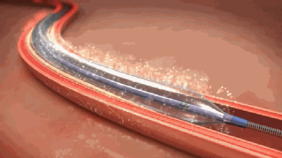 释放药物后,球囊撤岀,血管内不留异物.01,药物球囊扩张术