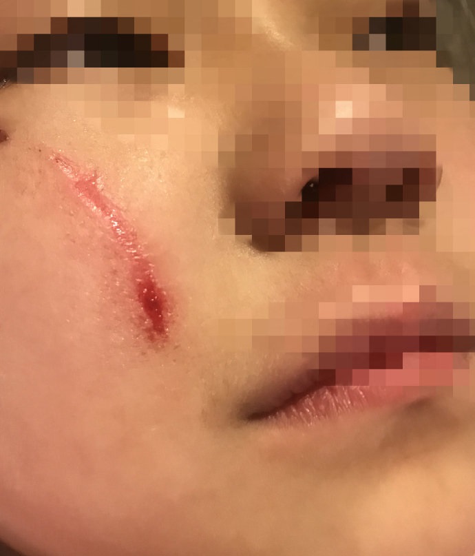可以清晰的看到,稚嫩的脸上确实有一条明显的伤疤,看后令人揪心!