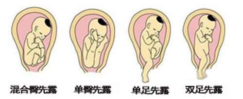 对胎位的描述LOA \ ROA \ LSA是????
