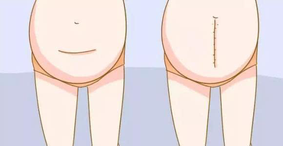 剖腹产,横竖都是一刀?有区别吗?