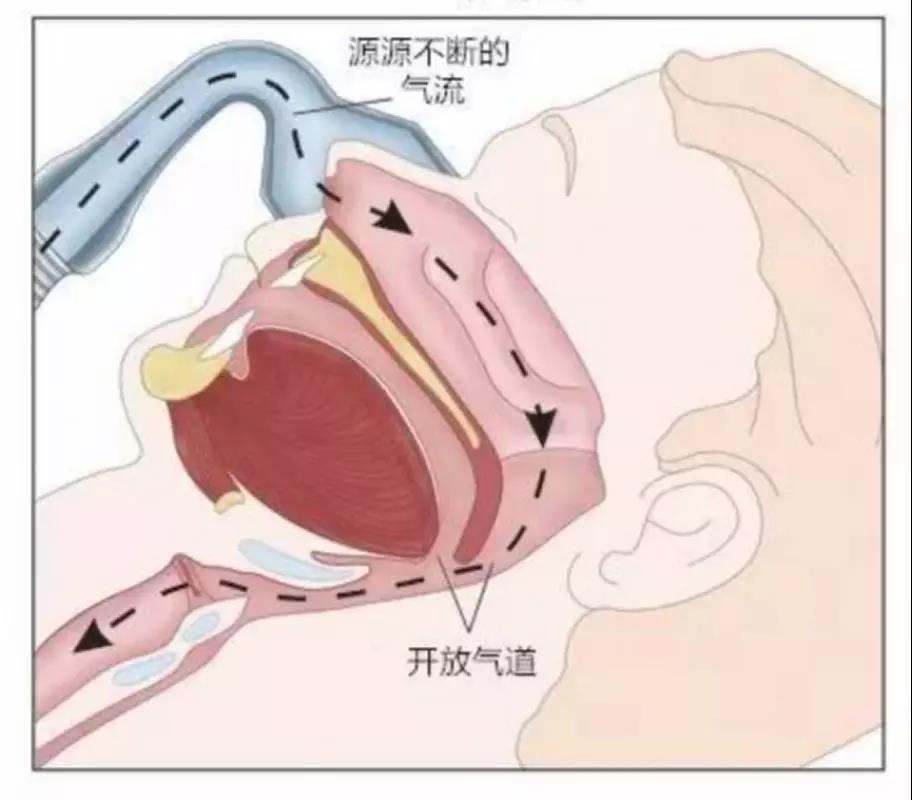 你知道吗,睡觉打呼是一种病!