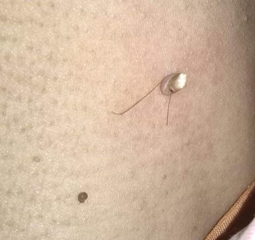 医生:极易传染,尽早医治|丝状疣|脖子|医生_新浪新闻