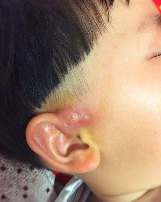 孩子耳朵上有个"小孔",宝妈用手挤了一下,医生:准备手术|耳朵|瘘管