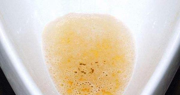 糖尿病患者夜尿变多是怎么回事?会是并发症引起的吗?