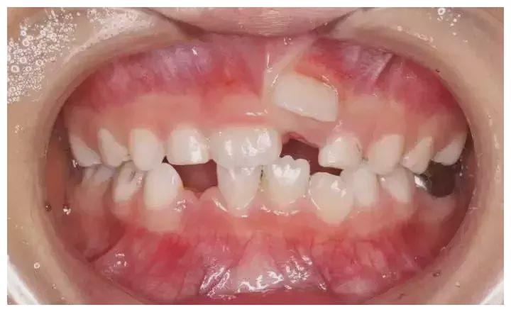 宝宝牙齿越换越难看,双排牙惹的祸?错!医生:喂养习惯危害太大