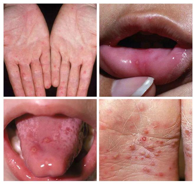 手足口病进入高发期,年轻爸妈要注意!