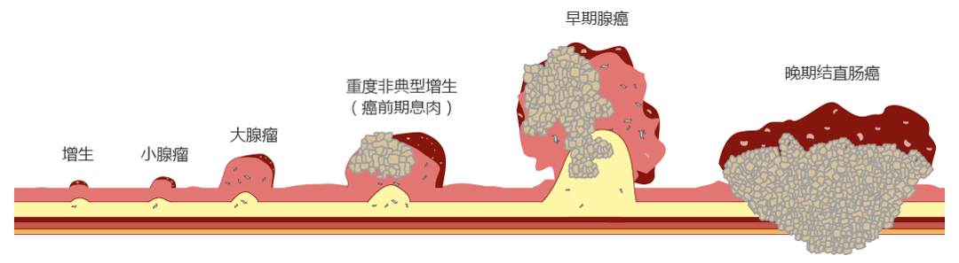雪崩来临前,没有一片雪花是无辜的|肠癌|雪崩|腺瘤_新浪新闻