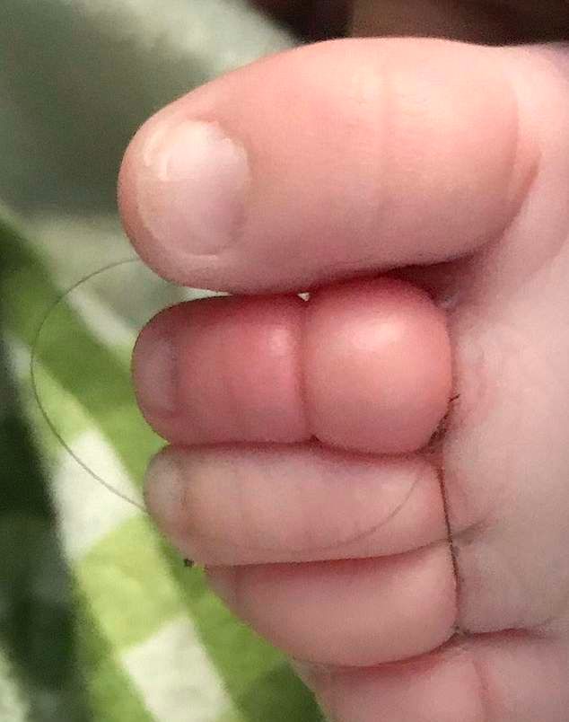 十周大的婴儿脚趾被母亲的头发缠住12小时,险些遭到截肢