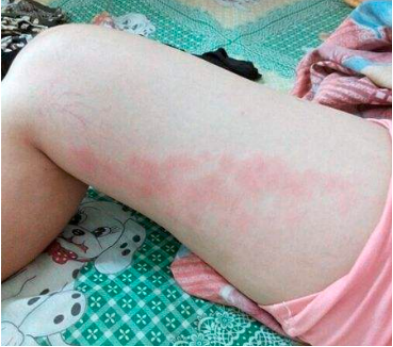 大腿内侧出现红疙瘩就是艾滋病不可妄下定论但也不能松懈