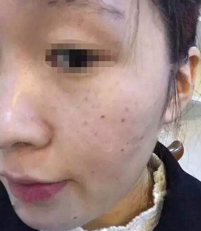 4种食物是黄褐斑的死对头聪明的女人常吃皮肤光滑不长斑