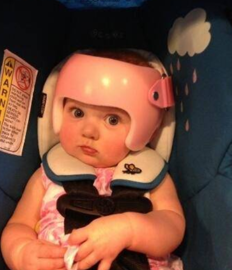 宝宝头部畸形戴头盔矫正,家人为陪伴都他戴头盔生活