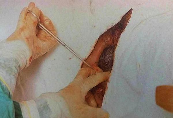 剖腹产的都要忍受小腹10公分左右的横切或者竖切.