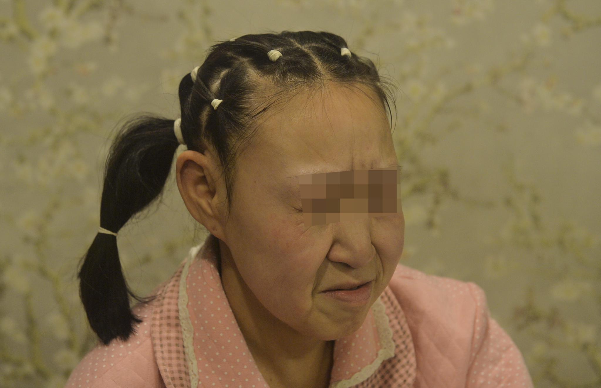 辽宁沈阳,备受世人关注的辽宁黑山15岁女孩小凤(化名)"换脸"手术如期