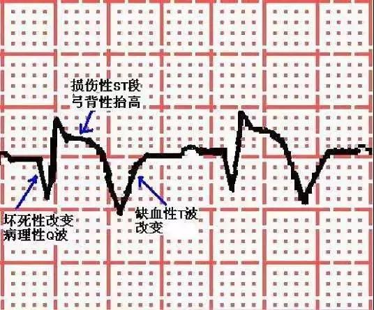 心肌梗死心电图表现