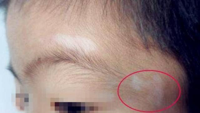 孩子出现这6种症状说明肚子里长蛔虫了家长该如何预防蛔虫