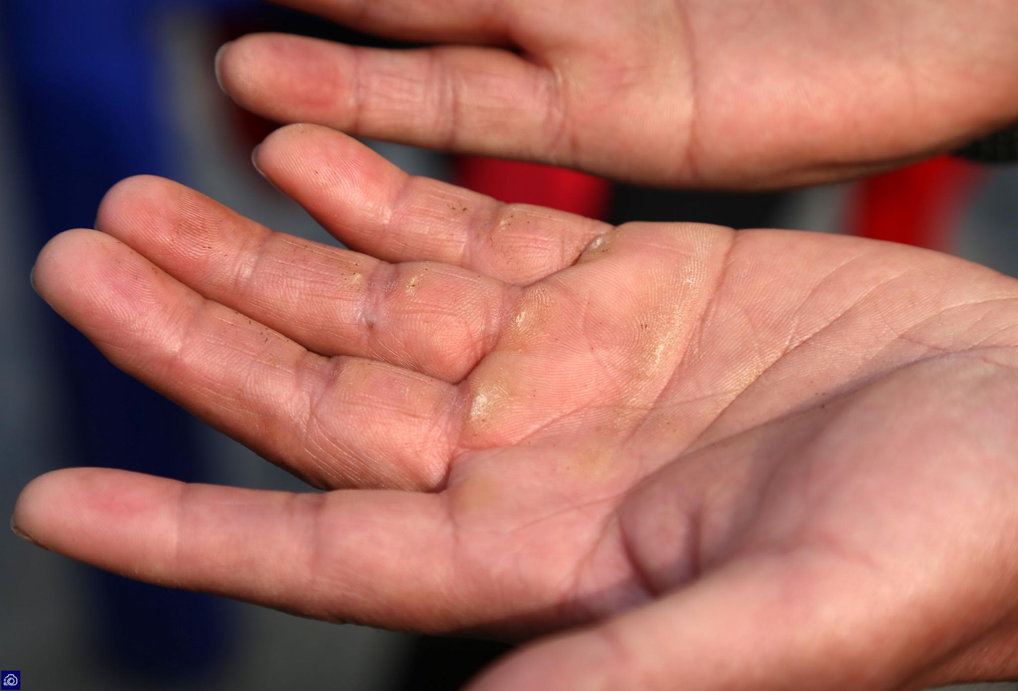 8年来,每天都要锻炼几个小时,苗志强手上磨出很多茧子.