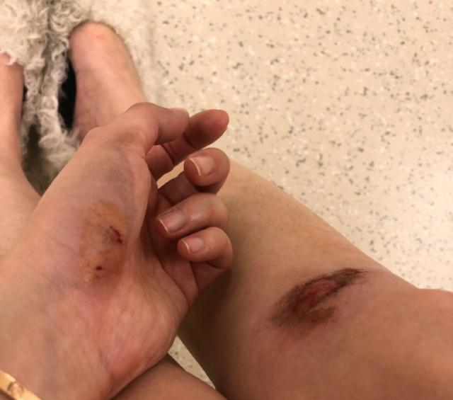 《天下足球》美女主持马凡舒受伤,膝盖青紫,依然坚持工作