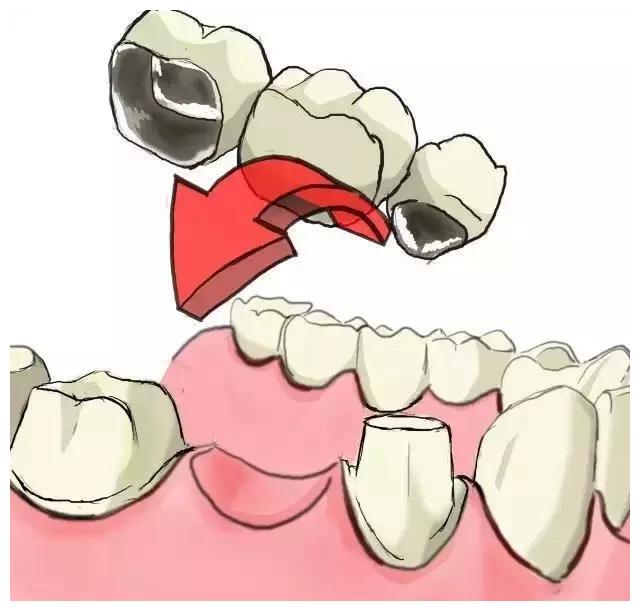 口腔修复,俗称镶牙,主要是针对牙齿缺损,牙齿缺失后的治疗工作,如嵌体