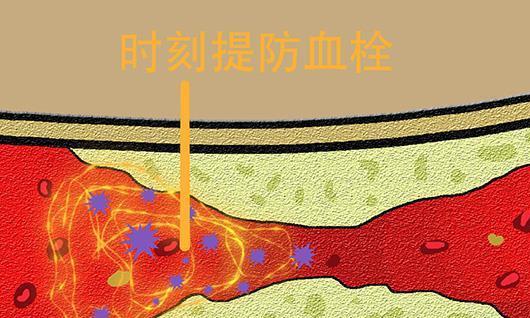 血栓其实不是绝症，“拴”住的往往是你的不重视|饮食_新浪新闻