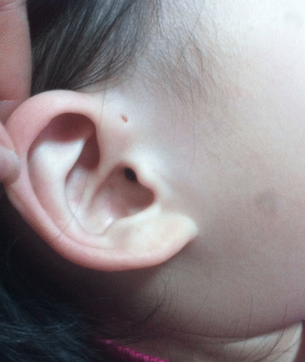 多数孩子耳朵上都有个小洞连王俊凯也有知道这小洞有何危害吗