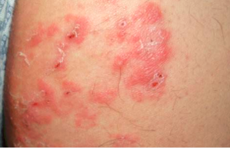 皮肤瘙痒溃烂是湿疹盯上你学会这1个外用方法让你一生受益