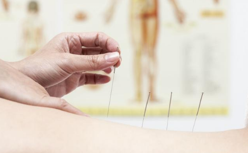 针灸可以缓解失眠吗?失眠的人,尝试一下