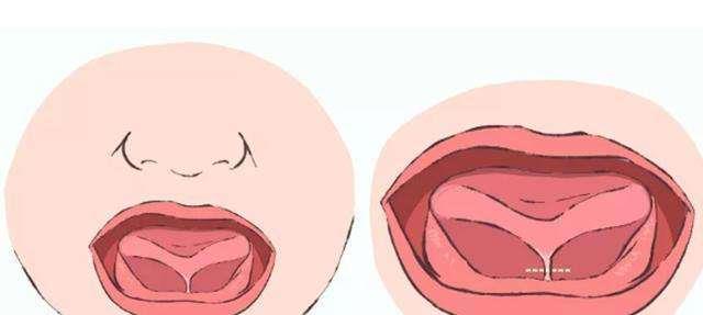 含糊,可能是舌系带过短的表现,家长要留心|舌系带|宝宝|舌头_新浪新闻