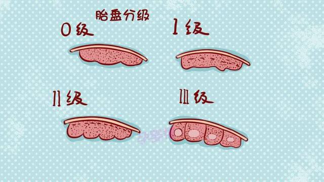 胎盘成熟度2级图片