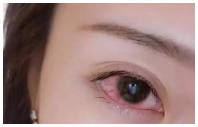 导致一只眼睛充血,劝各位以后少用|道具|美瞳|主播_新浪新闻