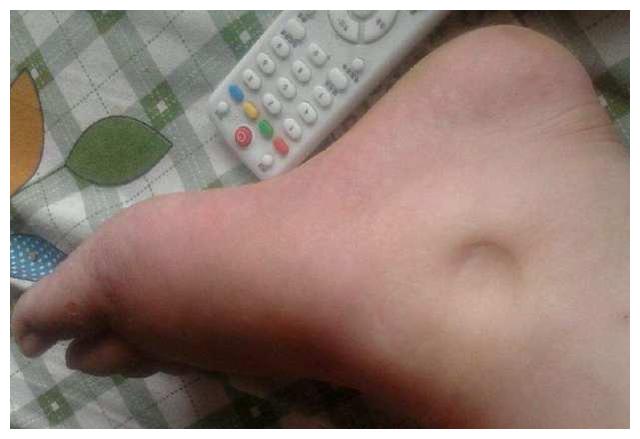 孕八个月脚肿的相片谁有我肿得厉害
