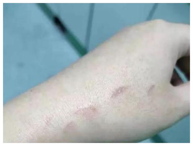 纷纷感叹道:上就出现了很多明显的抓痕,甚至有些皮肤都已经被小丽给抓