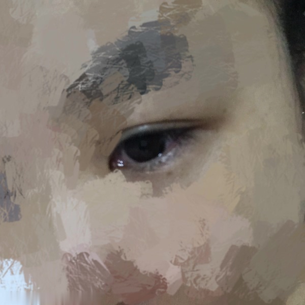 大家有没有得过或者发现红眼病患者眼睛什么样
