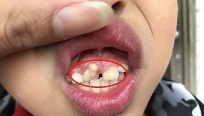 孩子换牙期间的4大问题,你了解越迟,孩子越受罪,颜值也受影响