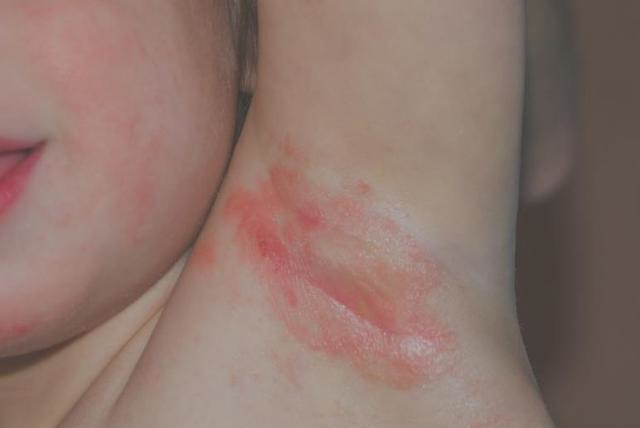 宝宝湿疹的3个治疗误区,别再走"弯路"了!