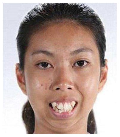 19龅牙妹喜从天降,免费整容后变大美女,成为模特嫁给富二代