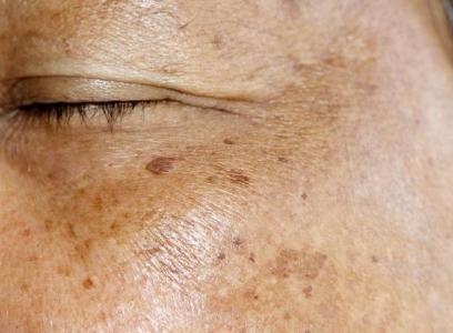 另外气滞血瘀,血行缓慢,肝脾肾三脏腑功能不调,也是常见导致黄褐斑的