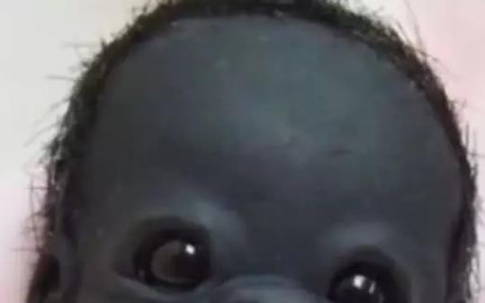 三年前被早产的圣婴被称世界最黑婴儿现在怎么样了
