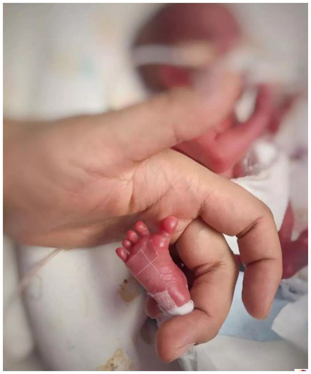 极早产婴儿出生仅29厘米,体重580克,在保温箱住140天后出院